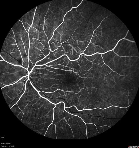 Elevated Episcleral Venous Pressure and Retinal Hemorrhages in both eyes
78 year old female with chronic red eye.   The eyes are red all the time now.  She is on Xeralto because of a history of blood clots in her lungs (2005 about).  She has not had problems since.  She has had floaters for many years.  Ever since her eyes got funny she sees more floaters in both eyes.  She had a brain scan over 6 months ago which was OK.  She also had double vision when this first started which went away.  She could not drive for a few months.  
VA OD: Dcc20/32-1 
VA OS: Dcc20/125 
IOP: TP: OD:17 OS:16
Neuroimaging did not show a CC fistula

