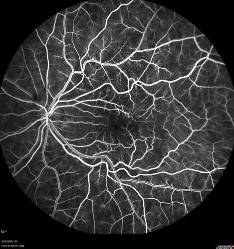 Elevated Episcleral Venous Pressure and Retinal Hemorrhages in both eyes
78 year old female with chronic red eye.   The eyes are red all the time now.  She is on Xeralto because of a history of blood clots in her lungs (2005 about).  She has not had problems since.  She has had floaters for many years.  Ever since her eyes got funny she sees more floaters in both eyes.  She had a brain scan over 6 months ago which was OK.  She also had double vision when this first started which went away.  She could not drive for a few months.  
VA OD: Dcc20/32-1 
VA OS: Dcc20/125 
IOP: TP: OD:17 OS:16
Neuroimaging did not show a CC fistula
