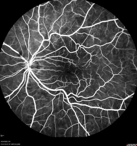 Elevated Episcleral Venous Pressure and Retinal Hemorrhages in both eyes
78 year old female with chronic red eye.   The eyes are red all the time now.  She is on Xeralto because of a history of blood clots in her lungs (2005 about).  She has not had problems since.  She has had floaters for many years.  Ever since her eyes got funny she sees more floaters in both eyes.  She had a brain scan over 6 months ago which was OK.  She also had double vision when this first started which went away.  She could not drive for a few months.  
VA OD: Dcc20/32-1 
VA OS: Dcc20/125 
IOP: TP: OD:17 OS:16
Neuroimaging did not show a CC fistula
