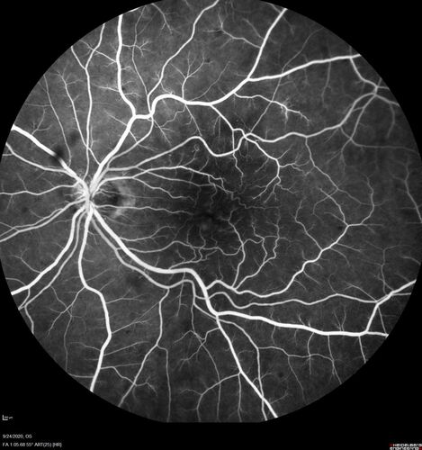 Elevated Episcleral Venous Pressure and Retinal Hemorrhages in both eyes
78 year old female with chronic red eye.   The eyes are red all the time now.  She is on Xeralto because of a history of blood clots in her lungs (2005 about).  She has not had problems since.  She has had floaters for many years.  Ever since her eyes got funny she sees more floaters in both eyes.  She had a brain scan over 6 months ago which was OK.  She also had double vision when this first started which went away.  She could not drive for a few months.  
VA OD: Dcc20/32-1 
VA OS: Dcc20/125 
IOP: TP: OD:17 OS:16
Neuroimaging did not show a CC fistula
