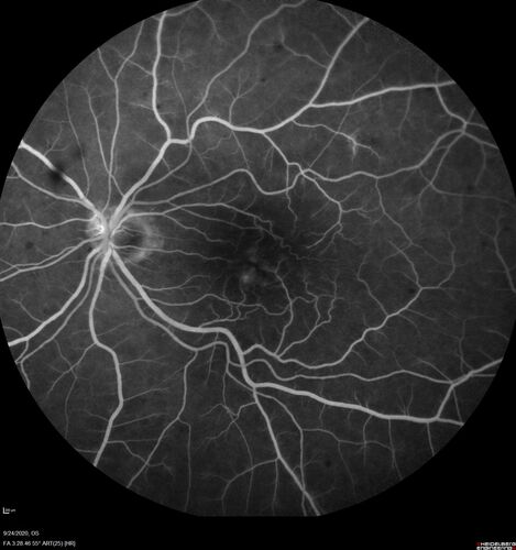 Elevated Episcleral Venous Pressure and Retinal Hemorrhages in both eyes
78 year old female with chronic red eye.   The eyes are red all the time now.  She is on Xeralto because of a history of blood clots in her lungs (2005 about).  She has not had problems since.  She has had floaters for many years.  Ever since her eyes got funny she sees more floaters in both eyes.  She had a brain scan over 6 months ago which was OK.  She also had double vision when this first started which went away.  She could not drive for a few months.  
VA OD: Dcc20/32-1 
VA OS: Dcc20/125 
IOP: TP: OD:17 OS:16
Neuroimaging did not show a CC fistula
