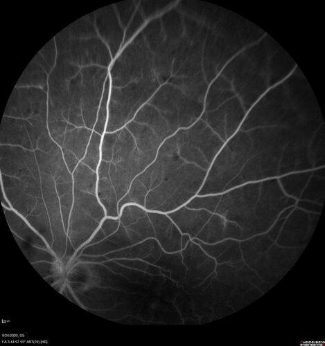 Elevated Episcleral Venous Pressure and Retinal Hemorrhages in both eyes
78 year old female with chronic red eye.   The eyes are red all the time now.  She is on Xeralto because of a history of blood clots in her lungs (2005 about).  She has not had problems since.  She has had floaters for many years.  Ever since her eyes got funny she sees more floaters in both eyes.  She had a brain scan over 6 months ago which was OK.  She also had double vision when this first started which went away.  She could not drive for a few months.  
VA OD: Dcc20/32-1 
VA OS: Dcc20/125 
IOP: TP: OD:17 OS:16
Neuroimaging did not show a CC fistula
