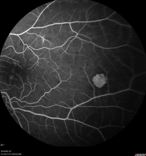Elevated Episcleral Venous Pressure and Retinal Hemorrhages in both eyes
78 year old female with chronic red eye.   The eyes are red all the time now.  She is on Xeralto because of a history of blood clots in her lungs (2005 about).  She has not had problems since.  She has had floaters for many years.  Ever since her eyes got funny she sees more floaters in both eyes.  She had a brain scan over 6 months ago which was OK.  She also had double vision when this first started which went away.  She could not drive for a few months.  
VA OD: Dcc20/32-1 
VA OS: Dcc20/125 
IOP: TP: OD:17 OS:16
Neuroimaging did not show a CC fistula
