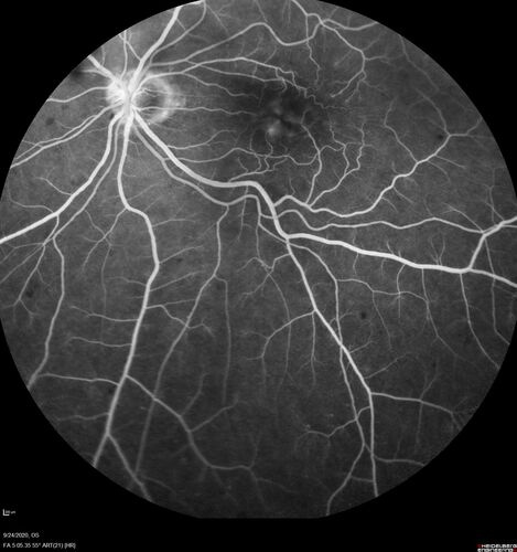 Elevated Episcleral Venous Pressure and Retinal Hemorrhages in both eyes
78 year old female with chronic red eye.   The eyes are red all the time now.  She is on Xeralto because of a history of blood clots in her lungs (2005 about).  She has not had problems since.  She has had floaters for many years.  Ever since her eyes got funny she sees more floaters in both eyes.  She had a brain scan over 6 months ago which was OK.  She also had double vision when this first started which went away.  She could not drive for a few months.  
VA OD: Dcc20/32-1 
VA OS: Dcc20/125 
IOP: TP: OD:17 OS:16
Neuroimaging did not show a CC fistula
