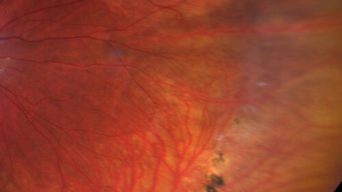 FEVR and Loeys-Deitz Syndrome - TGFBR gene defect
15 year old boy with Loeys-Deitz Syndrome. And TGFBR gene positivity.  At age 11 he had aortic root surgery.  VA 20/25 OU.  Anterior segment normal.  Retina shows findings consistent with mild familial exudative vitreoretinopathy
