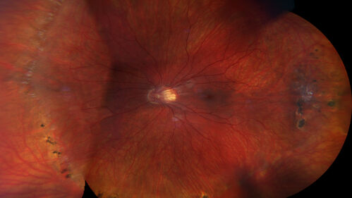 FEVR and Loeys-Deitz Syndrome - TGFBR gene defect
15 year old boy with Loeys-Deitz Syndrome. And TGFBR gene positivity.  At age 11 he had aortic root surgery.  VA 20/25 OU.  Anterior segment normal.  Retina shows findings consistent with mild familial exudative vitreoretinopathy
