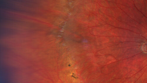 FEVR and Loeys-Deitz Syndrome - TGFBR gene defect
15 year old boy with Loeys-Deitz Syndrome. And TGFBR gene positivity.  At age 11 he had aortic root surgery.  VA 20/25 OU.  Anterior segment normal.  Retina shows findings consistent with mild familial exudative vitreoretinopathy
