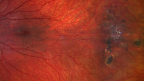 FEVR and Loeys-Deitz Syndrome - TGFBR gene defect
15 year old boy with Loeys-Deitz Syndrome. And TGFBR gene positivity.  At age 11 he had aortic root surgery.  VA 20/25 OU.  Anterior segment normal.  Retina shows findings consistent with mild familial exudative vitreoretinopathy
