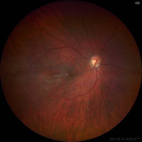 Familial Exudative Vitreoretinopathy - FEVR - Stage 1-b both eyes
She was born at term.Â Â Â No family history of eye disease.
VA OD: Dcc20/25, VA OS: Dcc20/200+1 Ncc20/400
Anterior segment normal â€“ clear lenses
