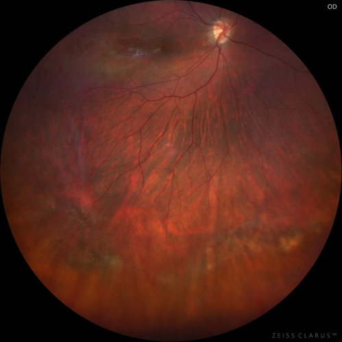 Familial Exudative Vitreoretinopathy - FEVR - Stage 1-b both eyes
She was born at term.Â Â Â No family history of eye disease.
VA OD: Dcc20/25, VA OS: Dcc20/200+1 Ncc20/400
Anterior segment normal â€“ clear lenses
