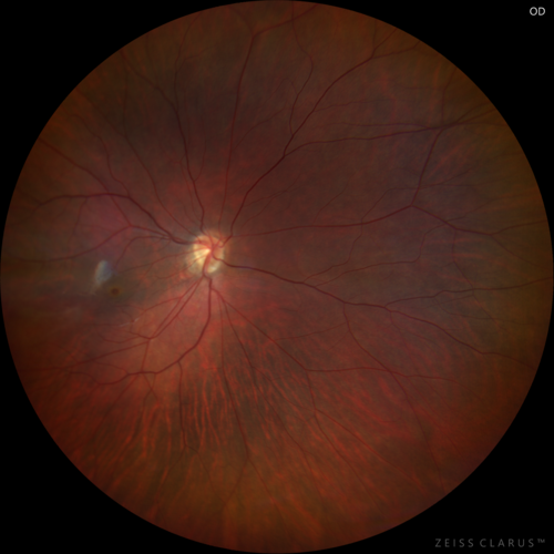 Familial Exudative Vitreoretinopathy - FEVR - Stage 1-b both eyes
She was born at term.Â Â Â No family history of eye disease.
VA OD: Dcc20/25, VA OS: Dcc20/200+1 Ncc20/400
Anterior segment normal â€“ clear lenses

