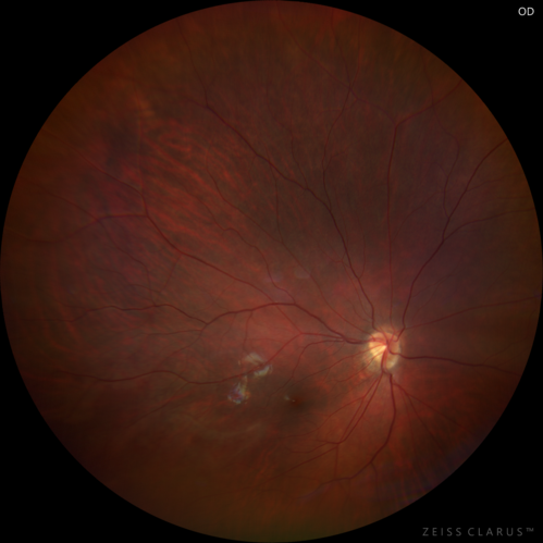 Familial Exudative Vitreoretinopathy - FEVR - Stage 1-b both eyes
She was born at term.Â Â Â No family history of eye disease.
VA OD: Dcc20/25, VA OS: Dcc20/200+1 Ncc20/400
Anterior segment normal â€“ clear lenses

