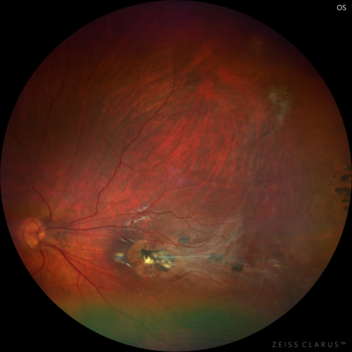 Familial Exudative Vitreoretinopathy - FEVR - Stage 1-b both eyes
She was born at term.Â Â Â No family history of eye disease.
VA OD: Dcc20/25, VA OS: Dcc20/200+1 Ncc20/400
Anterior segment normal â€“ clear lenses
