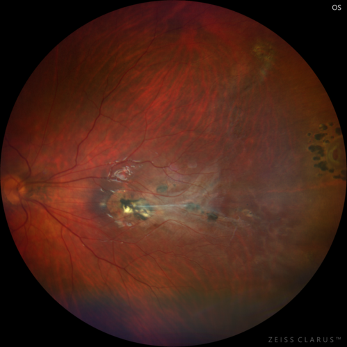 Familial Exudative Vitreoretinopathy - FEVR - Stage 1-b both eyes
She was born at term.Â Â Â No family history of eye disease.
VA OD: Dcc20/25, VA OS: Dcc20/200+1 Ncc20/400
Anterior segment normal â€“ clear lenses
