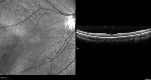Familial Exudative Vitreoretinopathy - FEVR - Stage 1-b both eyes
She was born at term.Â Â Â No family history of eye disease.
VA OD: Dcc20/25, VA OS: Dcc20/200+1 Ncc20/400
Anterior segment normal â€“ clear lenses
