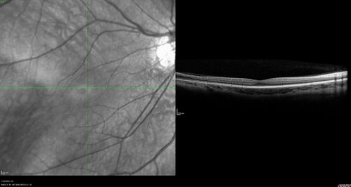 Familial Exudative Vitreoretinopathy - FEVR - Stage 1-b both eyes
She was born at term.Â Â Â No family history of eye disease.
VA OD: Dcc20/25, VA OS: Dcc20/200+1 Ncc20/400
Anterior segment normal â€“ clear lenses
