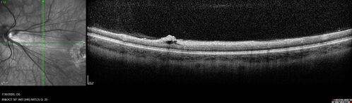 Familial Exudative Vitreoretinopathy - FEVR - Stage 1-b both eyes
She was born at term.Â Â Â No family history of eye disease.
VA OD: Dcc20/25, VA OS: Dcc20/200+1 Ncc20/400
Anterior segment normal â€“ clear lenses
