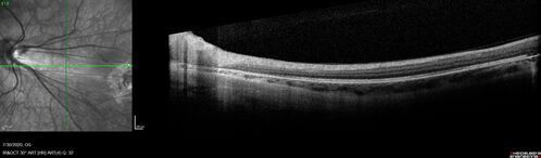 Familial Exudative Vitreoretinopathy - FEVR - Stage 1-b both eyes
She was born at term.Â Â Â No family history of eye disease.
VA OD: Dcc20/25, VA OS: Dcc20/200+1 Ncc20/400
Anterior segment normal â€“ clear lenses
