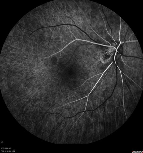 Familial Exudative Vitreoretinopathy - FEVR - Stage 1-b both eyes
She was born at term.Â Â Â No family history of eye disease.
VA OD: Dcc20/25, VA OS: Dcc20/200+1 Ncc20/400
Anterior segment normal â€“ clear lenses
