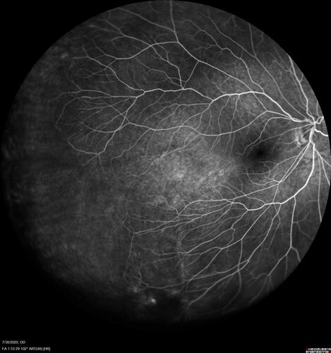 Familial Exudative Vitreoretinopathy - FEVR - Stage 1-b both eyes
She was born at term.Â Â Â No family history of eye disease.
VA OD: Dcc20/25, VA OS: Dcc20/200+1 Ncc20/400
Anterior segment normal â€“ clear lenses
