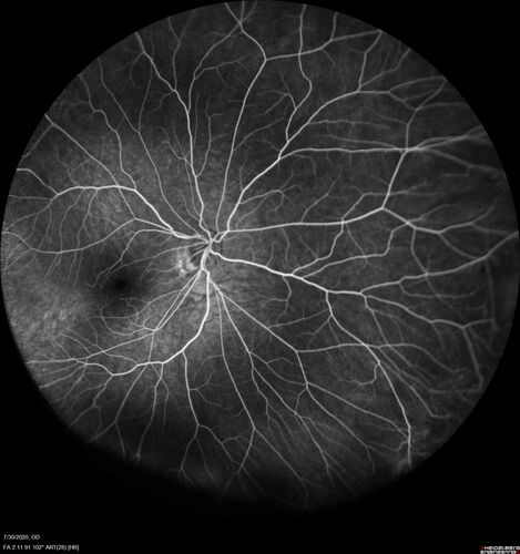 Familial Exudative Vitreoretinopathy - FEVR - Stage 1-b both eyes
She was born at term.Â Â Â No family history of eye disease.
VA OD: Dcc20/25, VA OS: Dcc20/200+1 Ncc20/400
Anterior segment normal â€“ clear lenses
