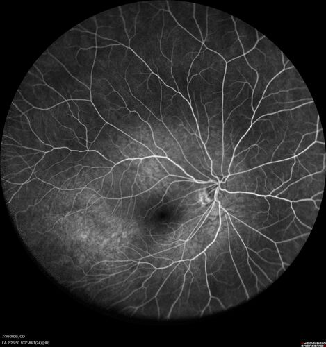 Familial Exudative Vitreoretinopathy - FEVR - Stage 1-b both eyes
She was born at term.Â Â Â No family history of eye disease.
VA OD: Dcc20/25, VA OS: Dcc20/200+1 Ncc20/400
Anterior segment normal â€“ clear lenses
