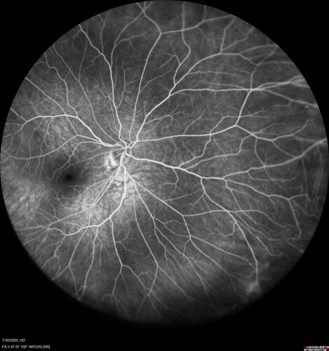 Familial Exudative Vitreoretinopathy - FEVR - Stage 1-b both eyes
She was born at term.Â Â Â No family history of eye disease.
VA OD: Dcc20/25, VA OS: Dcc20/200+1 Ncc20/400
Anterior segment normal â€“ clear lenses
