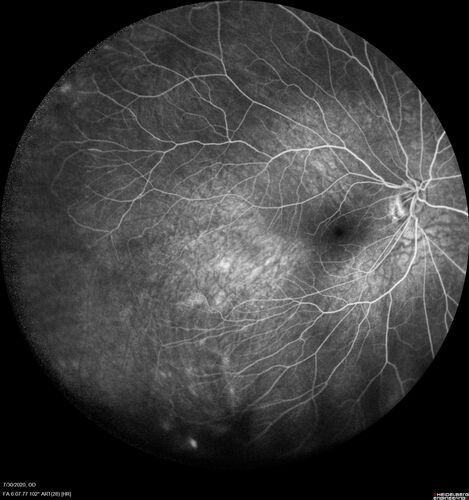 Familial Exudative Vitreoretinopathy - FEVR - Stage 1-b both eyes
She was born at term.Â Â Â No family history of eye disease.
VA OD: Dcc20/25, VA OS: Dcc20/200+1 Ncc20/400
Anterior segment normal â€“ clear lenses

