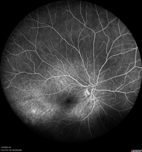 Familial Exudative Vitreoretinopathy - FEVR - Stage 1-b both eyes
She was born at term.Â Â Â No family history of eye disease.
VA OD: Dcc20/25, VA OS: Dcc20/200+1 Ncc20/400
Anterior segment normal â€“ clear lenses
