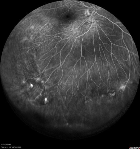 Familial Exudative Vitreoretinopathy - FEVR - Stage 1-b both eyes
She was born at term.Â Â Â No family history of eye disease.
VA OD: Dcc20/25, VA OS: Dcc20/200+1 Ncc20/400
Anterior segment normal â€“ clear lenses
