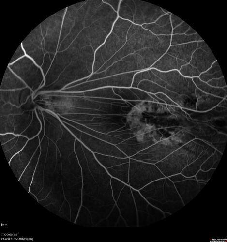 Familial Exudative Vitreoretinopathy - FEVR - Stage 1-b both eyes
She was born at term.Â Â Â No family history of eye disease.
VA OD: Dcc20/25, VA OS: Dcc20/200+1 Ncc20/400
Anterior segment normal â€“ clear lenses
