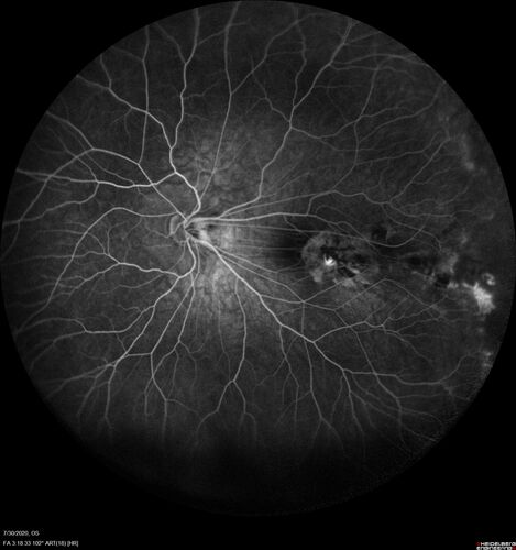 Familial Exudative Vitreoretinopathy - FEVR - Stage 1-b both eyes
She was born at term.Â Â Â No family history of eye disease.
VA OD: Dcc20/25, VA OS: Dcc20/200+1 Ncc20/400
Anterior segment normal â€“ clear lenses
