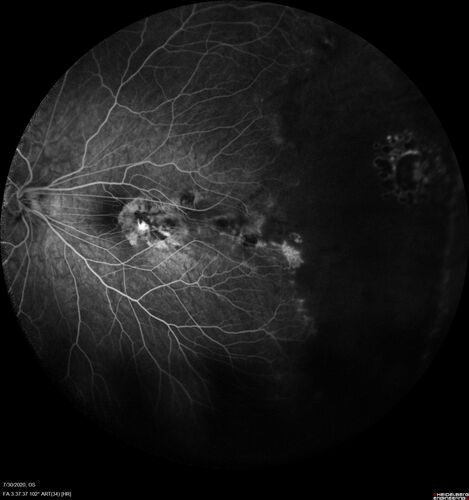 Familial Exudative Vitreoretinopathy - FEVR - Stage 1-b both eyes
She was born at term.Â Â Â No family history of eye disease.
VA OD: Dcc20/25, VA OS: Dcc20/200+1 Ncc20/400
Anterior segment normal â€“ clear lenses

