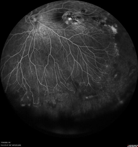 Familial Exudative Vitreoretinopathy - FEVR - Stage 1-b both eyes
She was born at term.Â Â Â No family history of eye disease.
VA OD: Dcc20/25, VA OS: Dcc20/200+1 Ncc20/400
Anterior segment normal â€“ clear lenses
