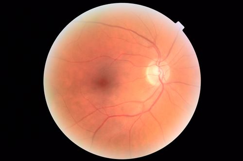 Foveal Red Spot Syndrome Left Eye
She noticed on covering the right eye that she had distortion off center in the left eye a few weeks ago.Â  She had a temporal paracentral scotoma intermittently visible on the eye examination.Â  She does notice that the left eye is not as good as the right eye now that it has been brought to her attention.Â  She has every now and then a little twitch in the left eye.Â  She has no pain on eye motion.Â Â 
VA OD: sc20/20 NccJ1+
VA OS: sc20/20-1
