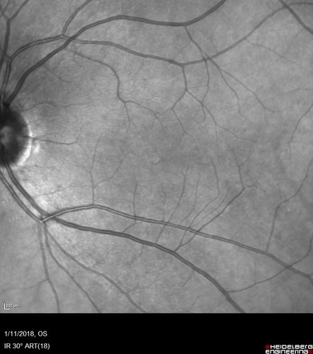 Foveal Red Spot Syndrome Left Eye
She noticed on covering the right eye that she had distortion off center in the left eye a few weeks ago.Â  She had a temporal paracentral scotoma intermittently visible on the eye examination.Â  She does notice that the left eye is not as good as the right eye now that it has been brought to her attention.Â  She has every now and then a little twitch in the left eye.Â  She has no pain on eye motion.Â Â 
VA OD: sc20/20 NccJ1+
VA OS: sc20/20-1
