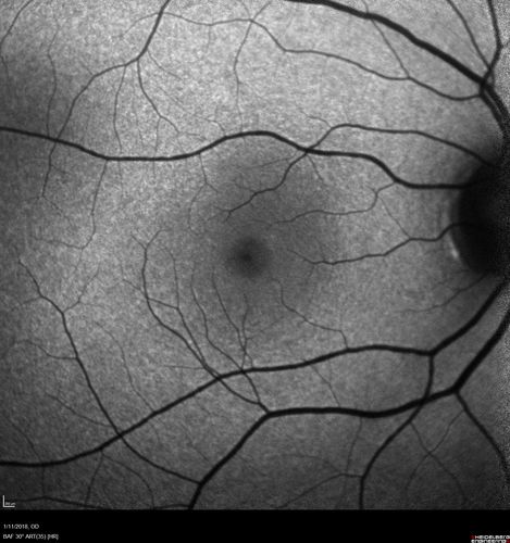 Foveal Red Spot Syndrome Left Eye
She noticed on covering the right eye that she had distortion off center in the left eye a few weeks ago.Â  She had a temporal paracentral scotoma intermittently visible on the eye examination.Â  She does notice that the left eye is not as good as the right eye now that it has been brought to her attention.Â  She has every now and then a little twitch in the left eye.Â  She has no pain on eye motion.Â Â 
VA OD: sc20/20 NccJ1+
VA OS: sc20/20-1
