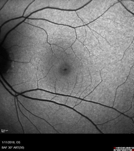 Foveal Red Spot Syndrome Left Eye
She noticed on covering the right eye that she had distortion off center in the left eye a few weeks ago.Â  She had a temporal paracentral scotoma intermittently visible on the eye examination.Â  She does notice that the left eye is not as good as the right eye now that it has been brought to her attention.Â  She has every now and then a little twitch in the left eye.Â  She has no pain on eye motion.Â Â 
VA OD: sc20/20 NccJ1+
VA OS: sc20/20-1
