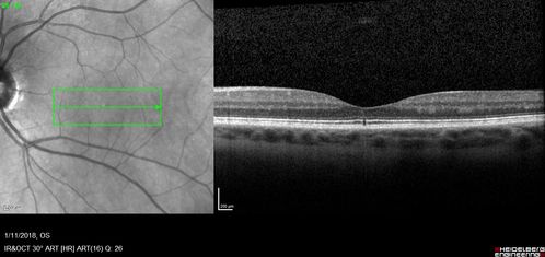 Foveal Red Spot Syndrome Left Eye
She noticed on covering the right eye that she had distortion off center in the left eye a few weeks ago.Â  She had a temporal paracentral scotoma intermittently visible on the eye examination.Â  She does notice that the left eye is not as good as the right eye now that it has been brought to her attention.Â  She has every now and then a little twitch in the left eye.Â  She has no pain on eye motion.Â Â 
VA OD: sc20/20 NccJ1+
VA OS: sc20/20-1

