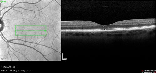 Foveal Red Spot Syndrome Left Eye
She noticed on covering the right eye that she had distortion off center in the left eye a few weeks ago.Â  She had a temporal paracentral scotoma intermittently visible on the eye examination.Â  She does notice that the left eye is not as good as the right eye now that it has been brought to her attention.Â  She has every now and then a little twitch in the left eye.Â  She has no pain on eye motion.Â Â 
VA OD: sc20/20 NccJ1+
VA OS: sc20/20-1
