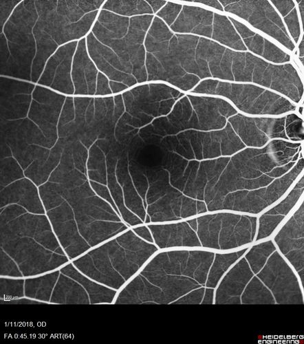 Foveal Red Spot Syndrome Left Eye
She noticed on covering the right eye that she had distortion off center in the left eye a few weeks ago.Â  She had a temporal paracentral scotoma intermittently visible on the eye examination.Â  She does notice that the left eye is not as good as the right eye now that it has been brought to her attention.Â  She has every now and then a little twitch in the left eye.Â  She has no pain on eye motion.Â Â 
VA OD: sc20/20 NccJ1+
VA OS: sc20/20-1
