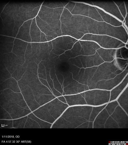 Foveal Red Spot Syndrome Left Eye
She noticed on covering the right eye that she had distortion off center in the left eye a few weeks ago.Â  She had a temporal paracentral scotoma intermittently visible on the eye examination.Â  She does notice that the left eye is not as good as the right eye now that it has been brought to her attention.Â  She has every now and then a little twitch in the left eye.Â  She has no pain on eye motion.Â Â 
VA OD: sc20/20 NccJ1+
VA OS: sc20/20-1
