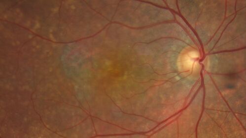 Geographic Atrophy with recent vision loss left eye
80 year old Recent vision loss in the left eye for about 6 weeks. 
Hyperlipidemia, HTN, Angina, history of TIAâ€™s
ASA daily
VA 20/25 OD, 20/63 OS (was 20/40 5/3/21 at patients first visit)
AC pseudophakic
