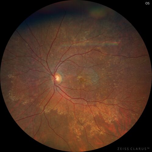 Geographic Atrophy with recent vision loss left eye
80 year old Recent vision loss in the left eye for about 6 weeks. 
Hyperlipidemia, HTN, Angina, history of TIAâ€™s
ASA daily
VA 20/25 OD, 20/63 OS (was 20/40 5/3/21 at patients first visit)
AC pseudophakic
