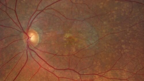 Geographic Atrophy with recent vision loss left eye
80 year old Recent vision loss in the left eye for about 6 weeks. 
Hyperlipidemia, HTN, Angina, history of TIAâ€™s
ASA daily
VA 20/25 OD, 20/63 OS (was 20/40 5/3/21 at patients first visit)
AC pseudophakic
