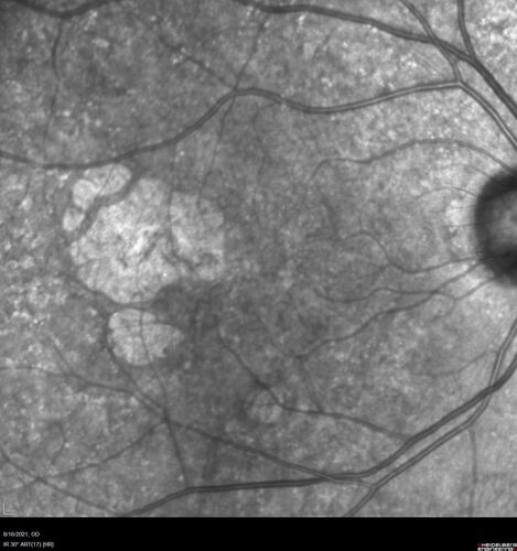 Geographic Atrophy with recent vision loss left eye
80 year old Recent vision loss in the left eye for about 6 weeks. 
Hyperlipidemia, HTN, Angina, history of TIAâ€™s
ASA daily
VA 20/25 OD, 20/63 OS (was 20/40 5/3/21 at patients first visit)
AC pseudophakic
