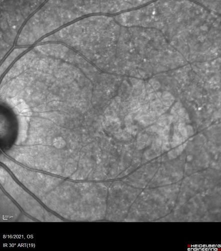 Geographic Atrophy with recent vision loss left eye
80 year old Recent vision loss in the left eye for about 6 weeks. 
Hyperlipidemia, HTN, Angina, history of TIAâ€™s
ASA daily
VA 20/25 OD, 20/63 OS (was 20/40 5/3/21 at patients first visit)
AC pseudophakic
