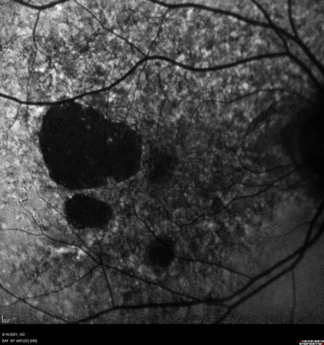 Geographic Atrophy with recent vision loss left eye
80 year old Recent vision loss in the left eye for about 6 weeks. 
Hyperlipidemia, HTN, Angina, history of TIAâ€™s
ASA daily
VA 20/25 OD, 20/63 OS (was 20/40 5/3/21 at patients first visit)
AC pseudophakic

