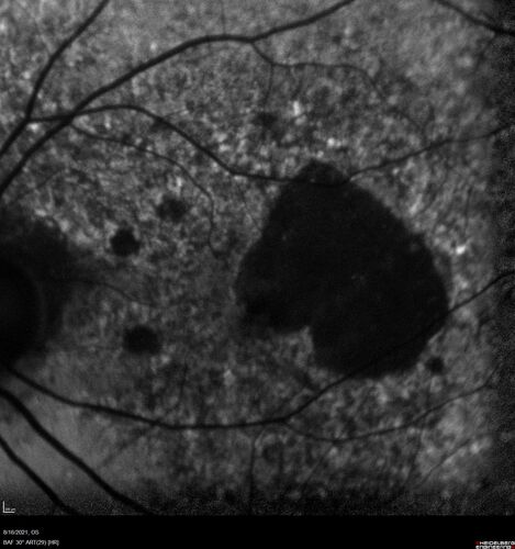 Geographic Atrophy with recent vision loss left eye
80 year old Recent vision loss in the left eye for about 6 weeks. 
Hyperlipidemia, HTN, Angina, history of TIAâ€™s
ASA daily
VA 20/25 OD, 20/63 OS (was 20/40 5/3/21 at patients first visit)
AC pseudophakic
