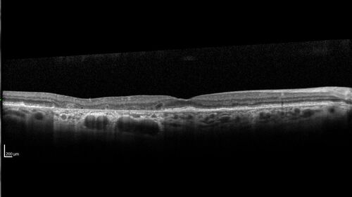 Geographic Atrophy with recent vision loss left eye
80 year old Recent vision loss in the left eye for about 6 weeks. 
Hyperlipidemia, HTN, Angina, history of TIAâ€™s
ASA daily
VA 20/25 OD, 20/63 OS (was 20/40 5/3/21 at patients first visit)
AC pseudophakic
